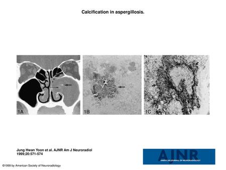 Calcification in aspergillosis.