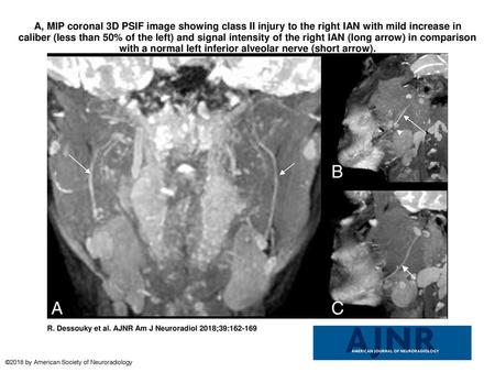 A, MIP coronal 3D PSIF image showing class II injury to the right IAN with mild increase in caliber (less than 50% of the left) and signal intensity of.