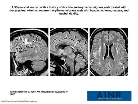 A 50-year-old woman with a history of tick bite and erythema migrans rash treated with doxycycline, who had recurrent erythema migrans rash with headache,