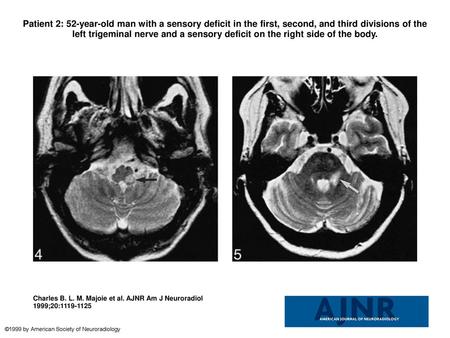 Patient 2: 52-year-old man with a sensory deficit in the first, second, and third divisions of the left trigeminal nerve and a sensory deficit on the right.