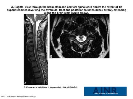 A, Sagittal view through the brain stem and cervical spinal cord shows the extent of T2 hyperintensities involving the pyramidal tract and posterior columns.