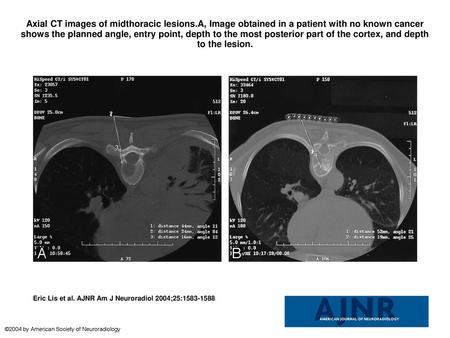 Axial CT images of midthoracic lesions