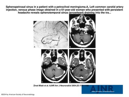 Sphenopetrosal sinus in a patient with a petroclival meningioma