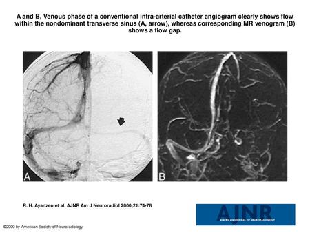 A and B, Venous phase of a conventional intra-arterial catheter angiogram clearly shows flow within the nondominant transverse sinus (A, arrow), whereas.