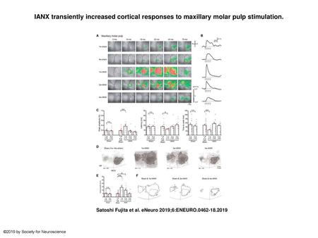 IANX transiently increased cortical responses to maxillary molar pulp stimulation. IANX transiently increased cortical responses to maxillary molar pulp.