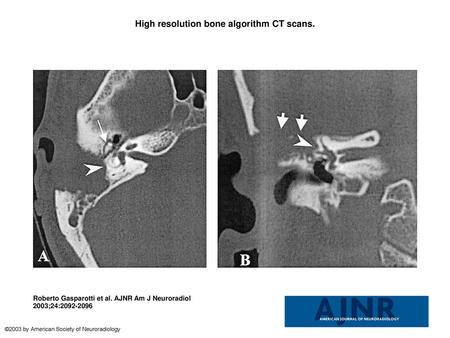 High resolution bone algorithm CT scans.