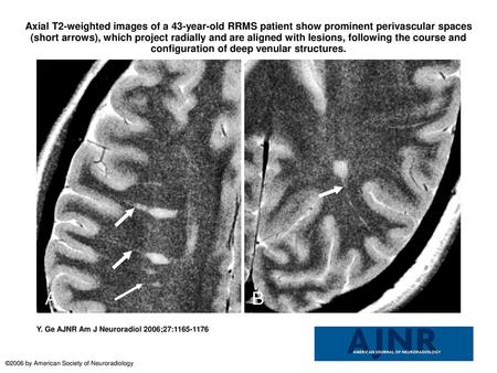 Axial T2-weighted images of a 43-year-old RRMS patient show prominent perivascular spaces (short arrows), which project radially and are aligned with lesions,