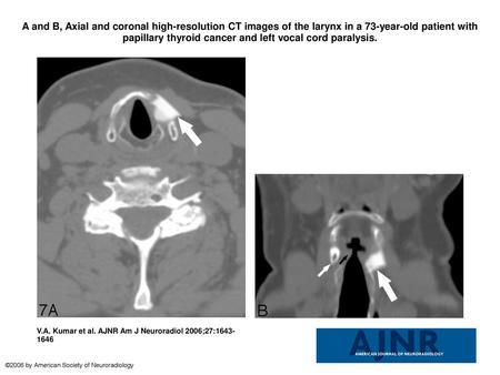 A and B, Axial and coronal high-resolution CT images of the larynx in a 73-year-old patient with papillary thyroid cancer and left vocal cord paralysis.