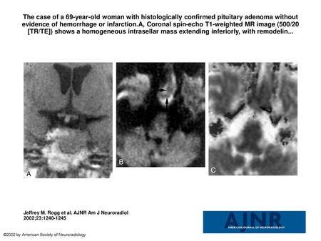 The case of a 69-year-old woman with histologically confirmed pituitary adenoma without evidence of hemorrhage or infarction.A, Coronal spin-echo T1-weighted.